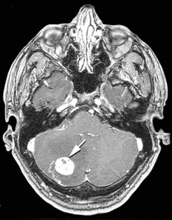 Description de l'image Hemangioblastoma cerebellum.jpg.