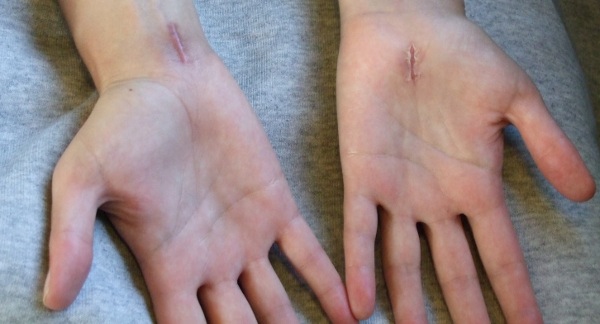 File:Carpal tunnel scars.jpg