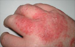 Dermatite da contatto sulla mano