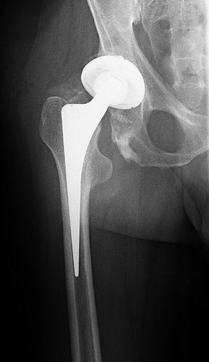Hip-Joint, total Replacement, insertion withou...