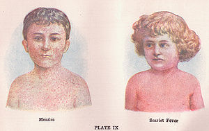 English: Illustrations of children with Measle...