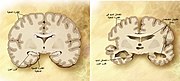 مقارنةٌ بين دماغٍ سليم في مرحلة الشيخوخة (اليسار) ودماغٍ لشخصٍ مصابٍ بآلزهايمر (اليمين). تظهرُ الفروقات بين الدماغين على الصُورة