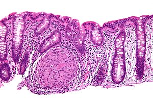 Esophagus - intermed mag. Image:Crohn's diseas...