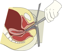 Revisione della cavità uterina
