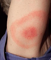Large erythematous patch in the pattern of a "bull's-eye" on a woman's posterior upper arm