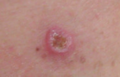 Malignant Melanoma, right posterior thigh