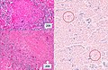 Histopathology, showing epithelioid granulomas with multinucleated giant cells and acid-fast bacilli