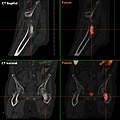 Osteoplastische Knochenmetastase eines metastasierten Prostata-Karzinoms im Hüftgelenk