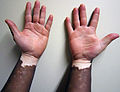 Vitiligo on darker skin