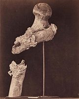 Zlomená stehenní kost poručíka Goodwina, 7 měsíců po zranění střelou, 1865