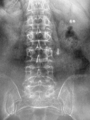 Medical X-rays, kidney and ureter stones.