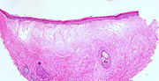 Lichen sclerosus (atrophische Form)
