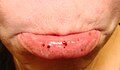 Oral petechiae/purpura - lower lip