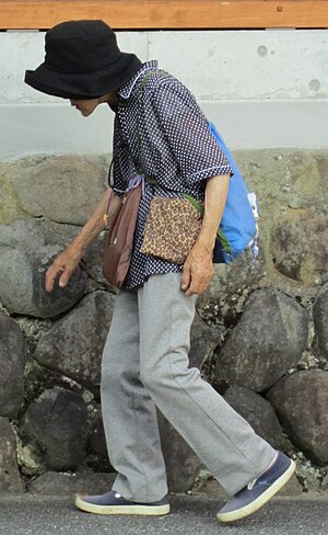 English: An osteoporotic elderly women in Japan.