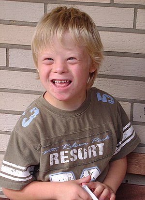 8-year-old boy with Down Syndrome