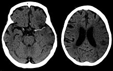 Dense artery sign in a patient with middle cerebral artery infarction shown on the left. Right image after 7 hours. Dens media sign mit Mediainfarkt - CCT 001.jpg