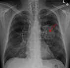 Chest X-ray showing lung cancer