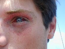 Oko a okolní kůže mladého muže vykazující petechiální a subkonjunktivální hemoragie