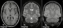 Examples of T1-weighted, T2-weighted and PD-weighted MRI scans T1t2PD.jpg