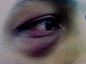 English: Close-up of a black eye after a few d...