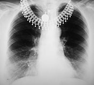 Chest x-ray