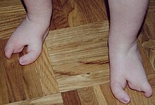 כפות רגליים של ילד בן שנה הלוקה באקטרודקטיליה