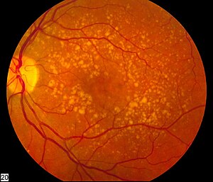 Intermediate age related macular degeneration.jpg