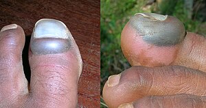 Injured toe nail - 3 days after the accident