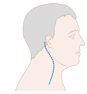 Diagram ukazující linii jizev po disekci lymfatických uzlin na krku CRUK 368.svg