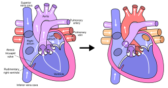 Fontan procedure.svg