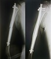 Остеосинтез плечової кістки інтрамедулярним стержнем одразу після операції та після зрощення, малоінвазивне виконання (мінімальні розрізи), впродовж загоювання пацієнт може користуватись кінцівкою