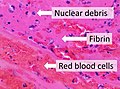 Σύνθεση φρέσκου θρόμβου σε μικροσκόπηση, που δείχνει πυρηνικά συντρίμμια σε φόντο ινώδους και ερυθρών αιμοσφαιρίων.
