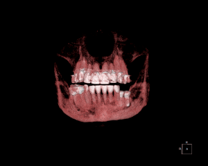 Animated gif of CBCT Dental implant