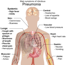 http://upload.wikimedia.org/wikipedia/commons/thumb/0/07/Main_symptoms_of_infectious_pneumonia.png/220px-Main_symptoms_of_infectious_pneumonia.png