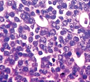 Ductal carcinoma with mild nuclear pleomorphism.