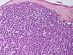 SkinTumors-P6180318.JPG