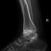 Боковая рентгенография голеностопного сустава при вторичном остеоартрозе