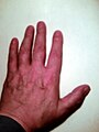 Results of a 2003 fracture of the third finger, left hand - the finger can no longer lie flat on a level surface.