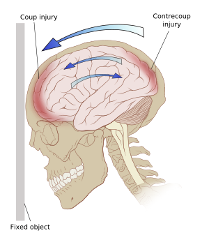 A diagram of the forces on the brain in a coup...