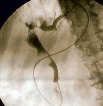 Fluoroscopic image of :en:common bile duct sto...