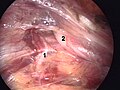 Ramus genitalis nervi genitofemoralis (1) in canale inguinali