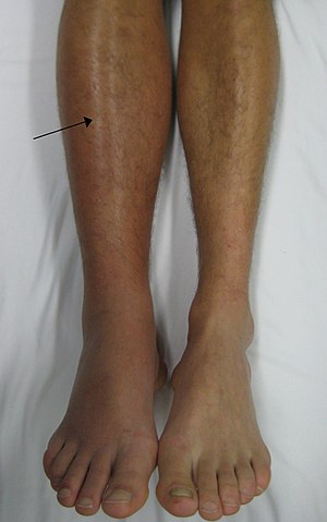 A deep vein thrombosis of the right leg. Note ...
