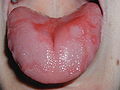 Another example of geographic tongue, showing strong color contrast between the red and white areas.