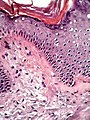 Histopathology of lichen amyloidosis, with subepithelial Congo red-positive deposits