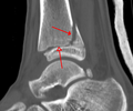 A triplane fracture of the ankle as seen on CT