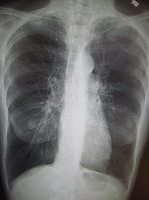A chest X-ray demonstrating severe COPD. Note ...