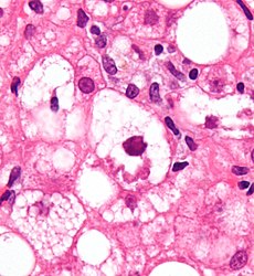 Liver Enzymes In Acute Alcoholic Hepatitis