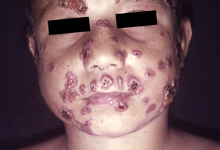 Lesions due to Paracoccidioidomycosis on the face of a Brazilian child Paracoccidioidomycosis lesions.png