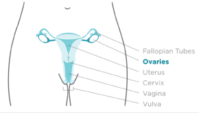 Site of ovarian cancer Site of ovarian cancer.png