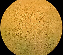 http://upload.wikimedia.org/wikipedia/commons/thumb/0/0c/Haematuria.jpg/250px-Haematuria.jpg